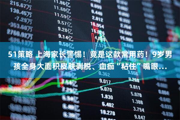 51策略 上海家长警惕！竟是这款常用药！9岁男孩全身大面积皮肤剥脱、血痂“粘住”嘴眼…